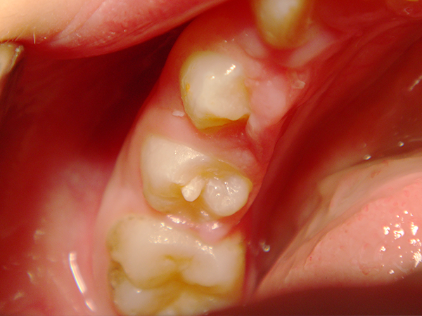 歯の形態の異常「中心結節」の治療